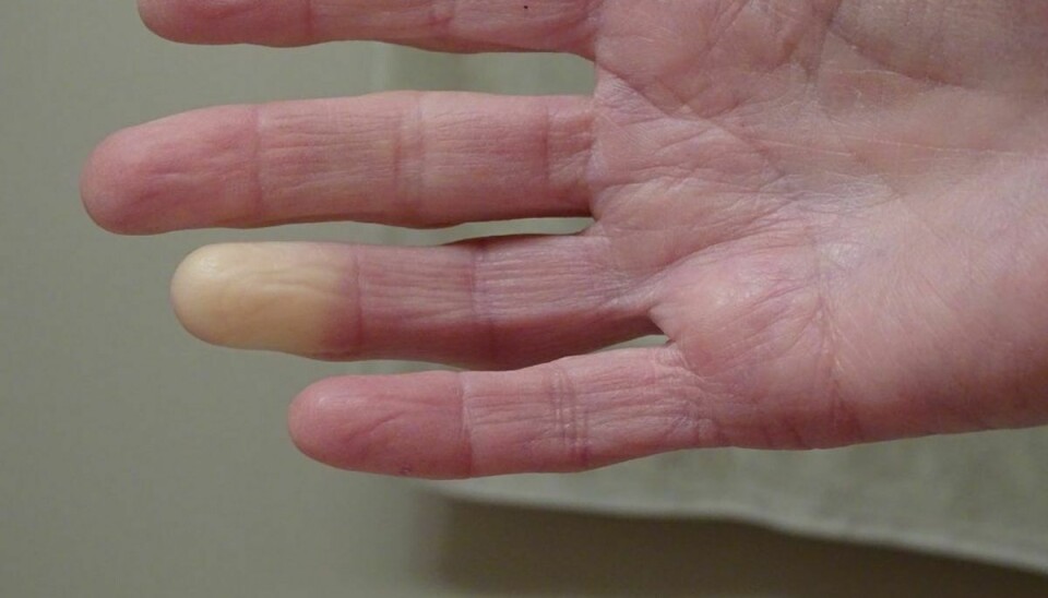 Raynauds sygdom giver dårlig blodcirkulation i fingre og tæer, og det kan være særdeles smertefuldt. Foto: Scanpix