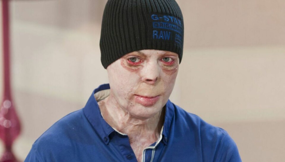 Martyn Compton blev hårdt såret og voldsomt forbrændt ved en eksplosion i Afghanistan tilbage i 2006. Klik videre for flere billeder. Foto: Ken Mckay/Shutterstock/Ritzau Scanpix. Martyn Compton blev hårdt såret og voldsomt forbrændt ved en eksplosion i Afghanistan tilbage i 2006. Klik videre for flere billeder. Foto: Ken Mckay/Shutterstock/Ritzau Scanpix.